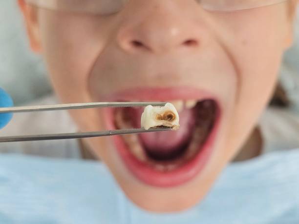 Best Cracked Tooth Emergency Dentist  in Ontario, CA